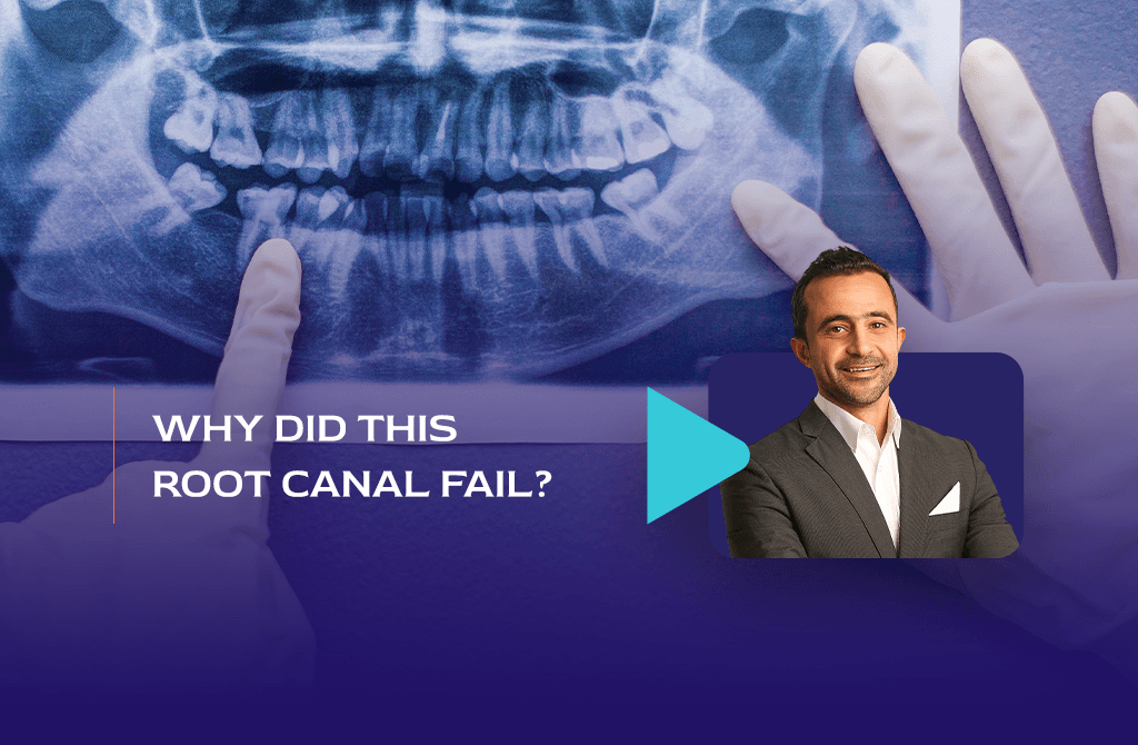 Why Did This Root Canal Fail? The Real Reasons Behind Post-Treatment Disease