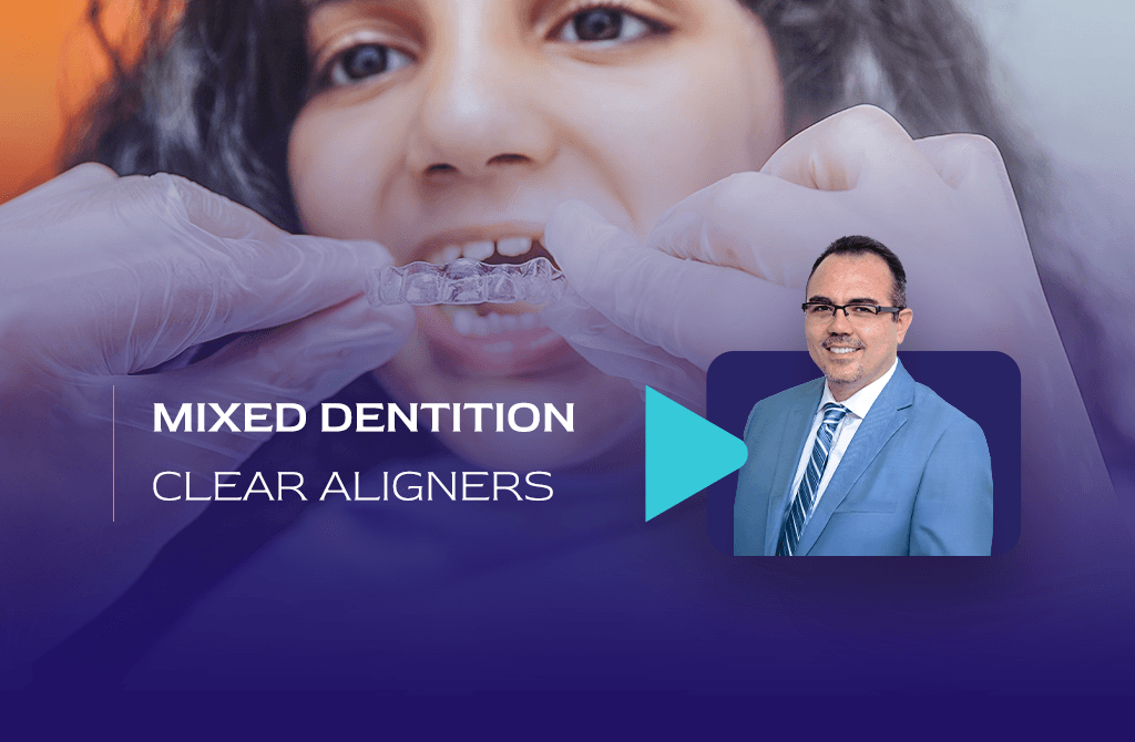 Special Considerations for Treatment Planning in Mixed Dentition with Clear Aligners