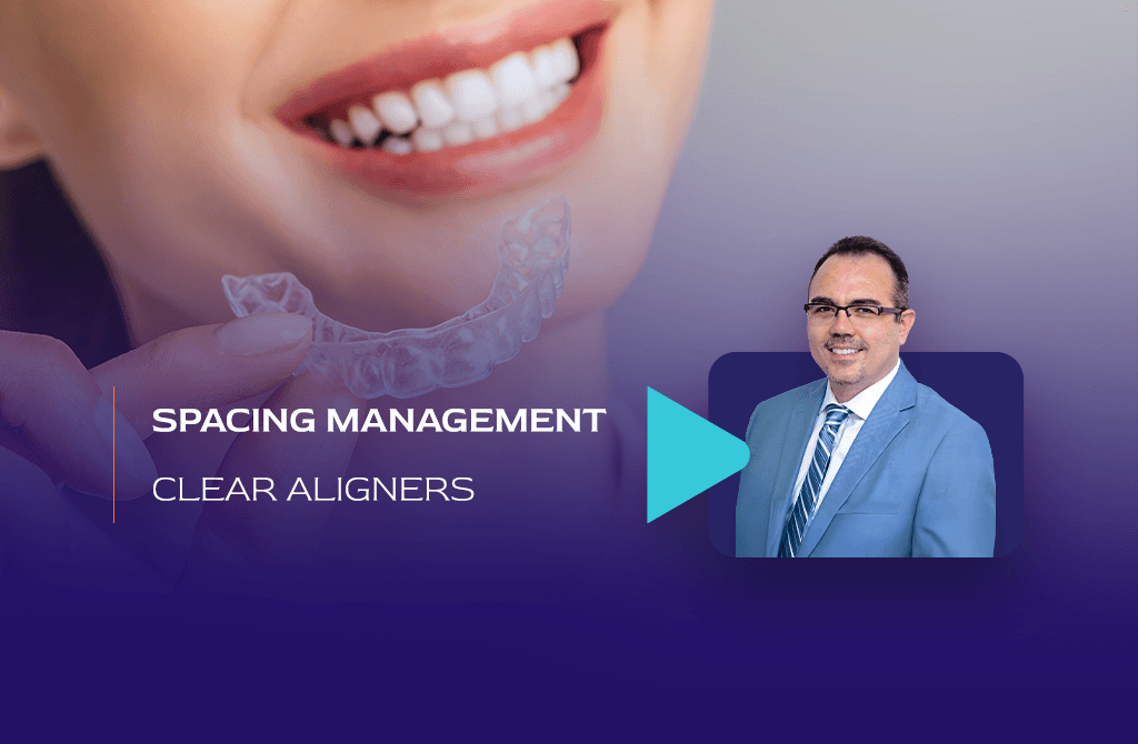 Seamless Smiles: Mastering Spacing Management with Clear Aligners: What Should You know?